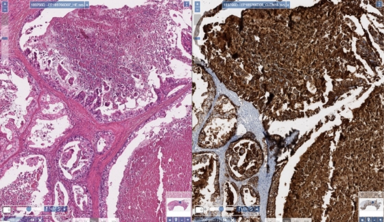 Matched H&E and IHC stain of gastric tumor necrosis (10x magnification)