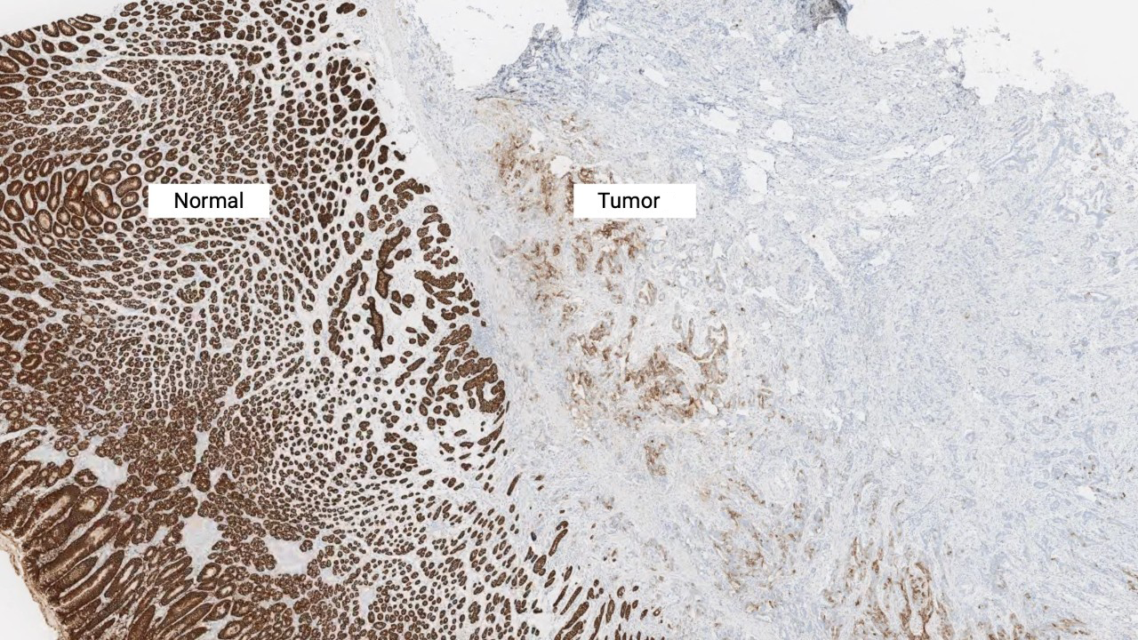 2x magnification of CLDN18-stained normal gastric epithelium and tumor cells.