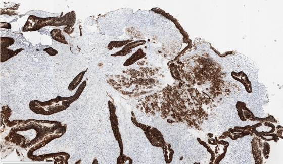 5x magnification of CLDN18-stained tumor sample with surrounding normal gastric glands.