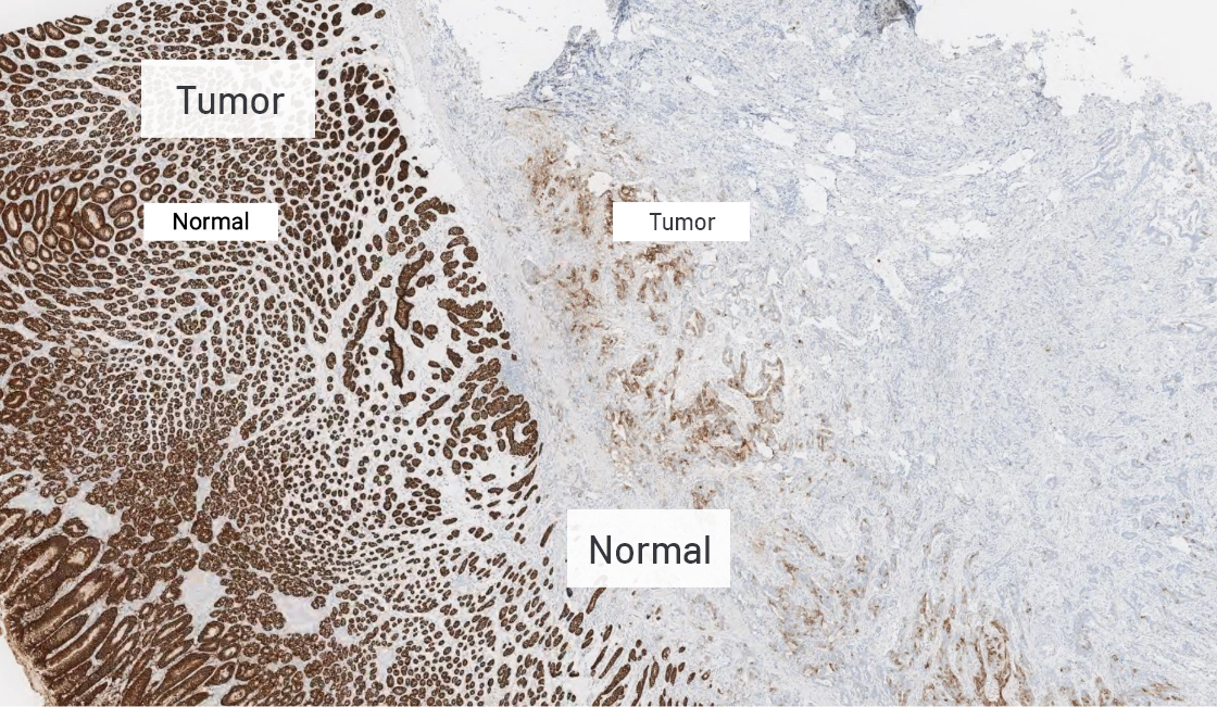 Normal and tumour cell CLDN18.2 staining at 5x magnification